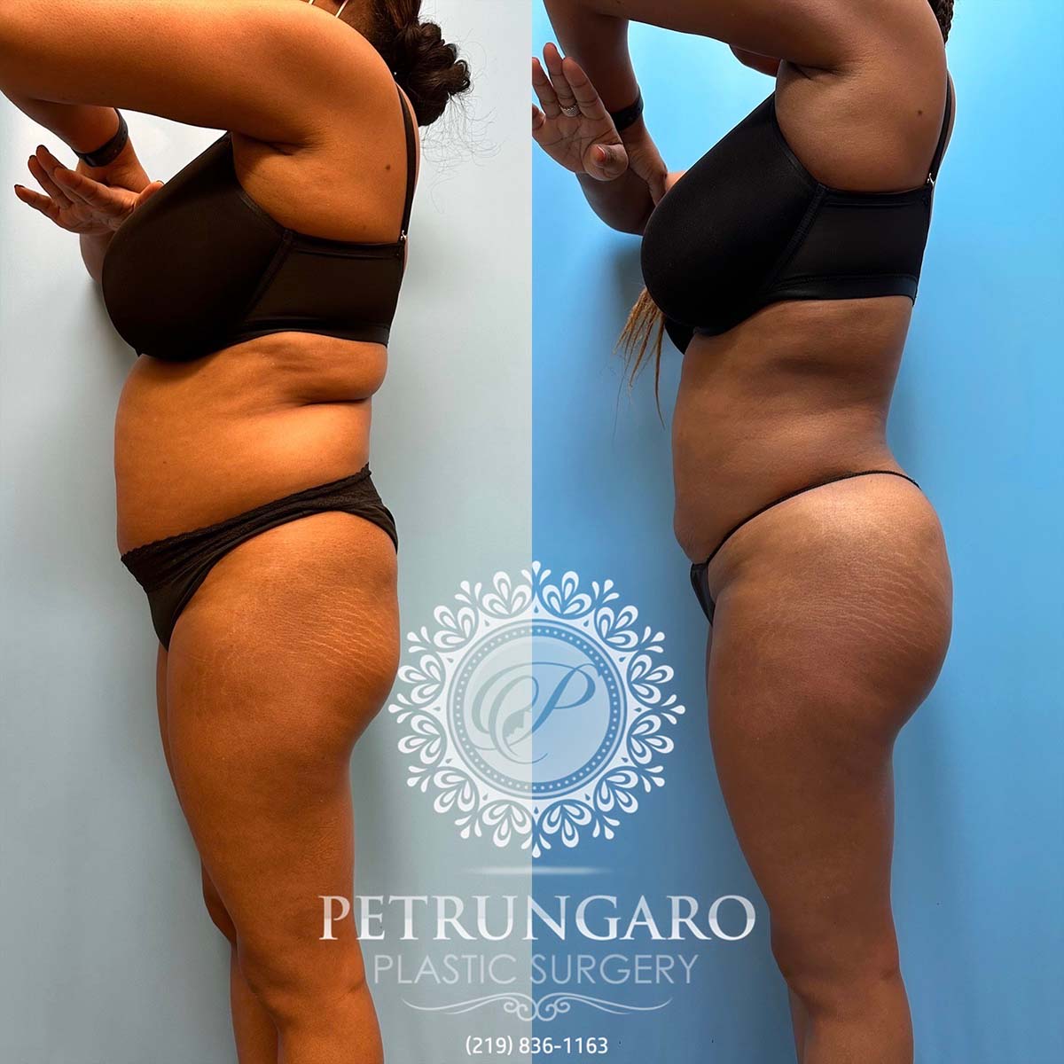 48-f-brazilian-butt-lift-liposuction-360-renuvion-1