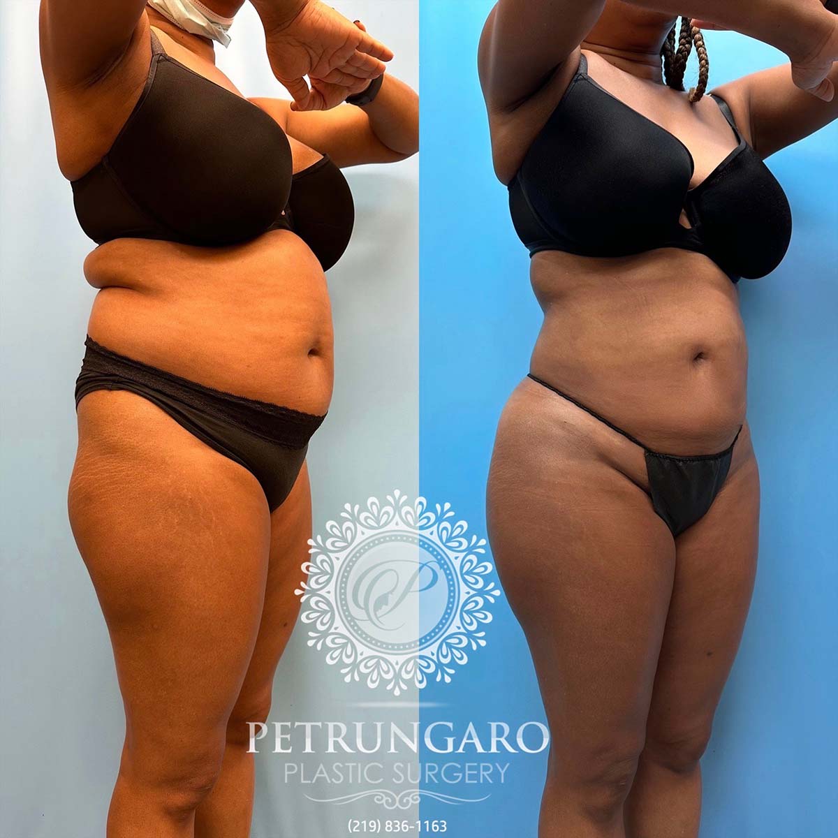 48-f-brazilian-butt-lift-liposuction-360-renuvion-3