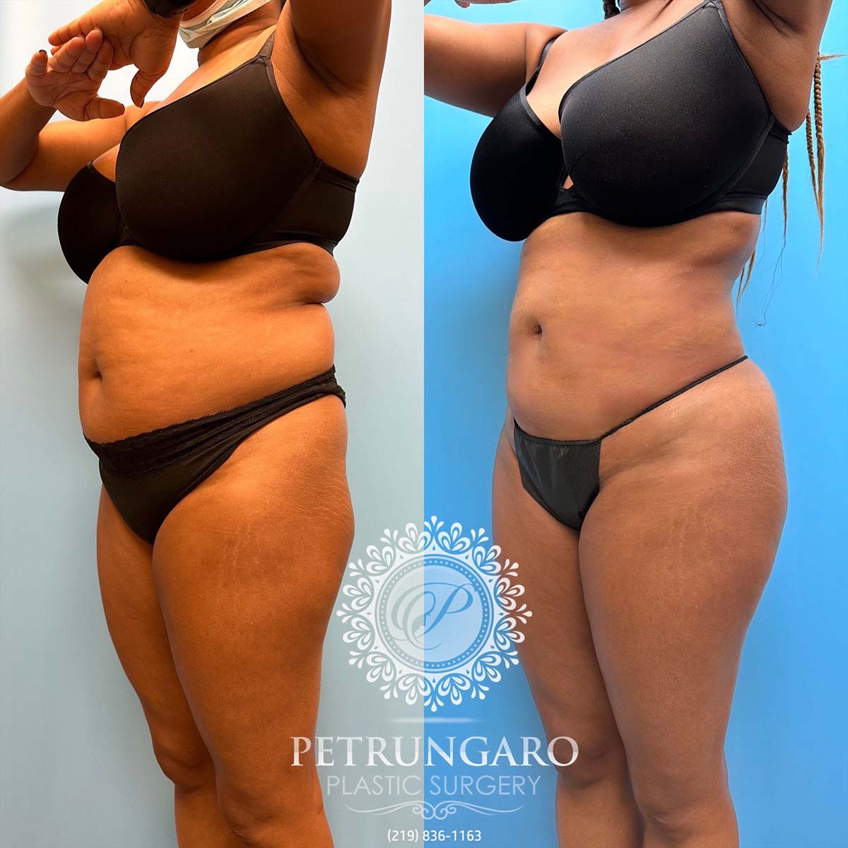 48-f-brazilian-butt-lift-liposuction-360-renuvion-4