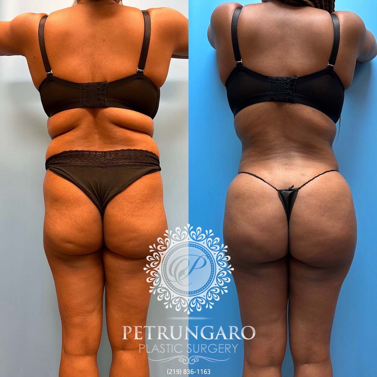 48-f-brazilian-butt-lift-liposuction-360-renuvion-5