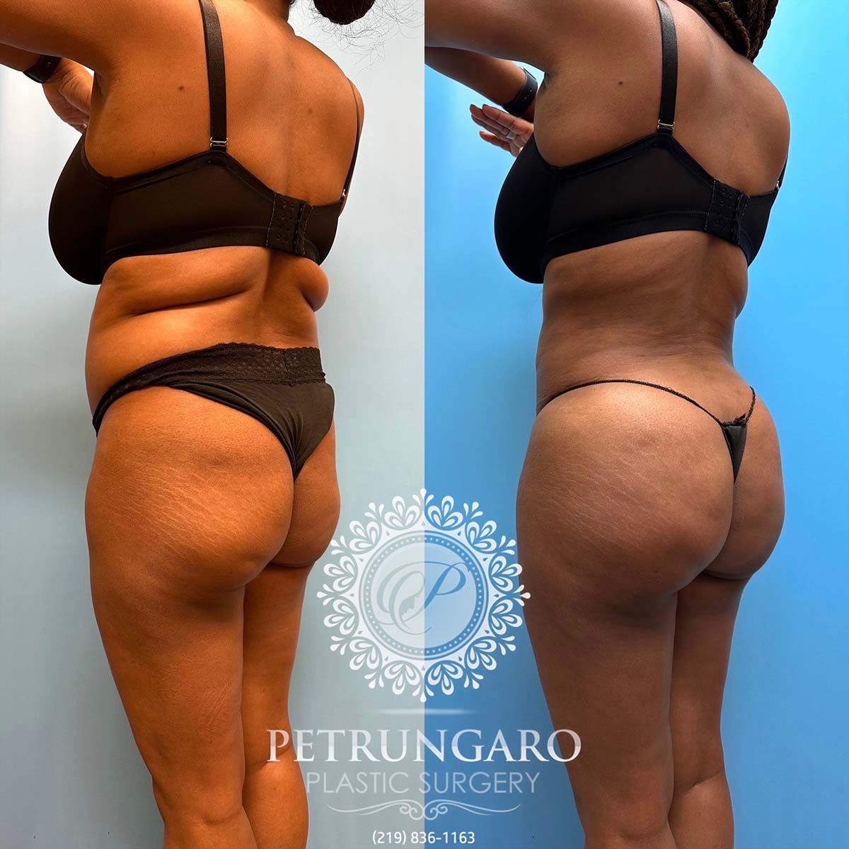 48-f-brazilian-butt-lift-liposuction-360-renuvion-6