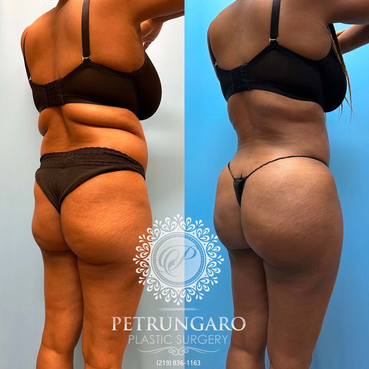 48-f-brazilian-butt-lift-liposuction-360-renuvion-7