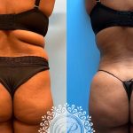 48-f-brazilian-butt-lift-liposuction-360-renuvion-featured